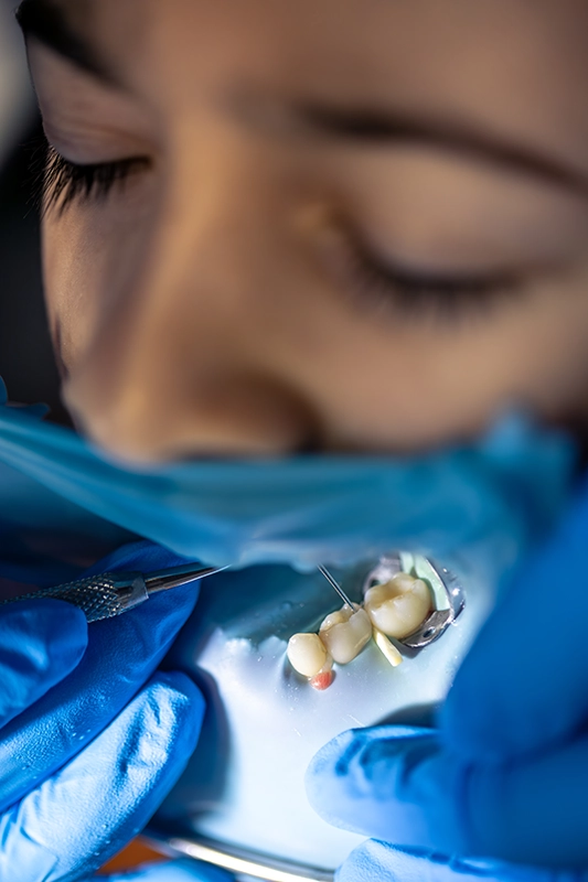 Dental Implants
